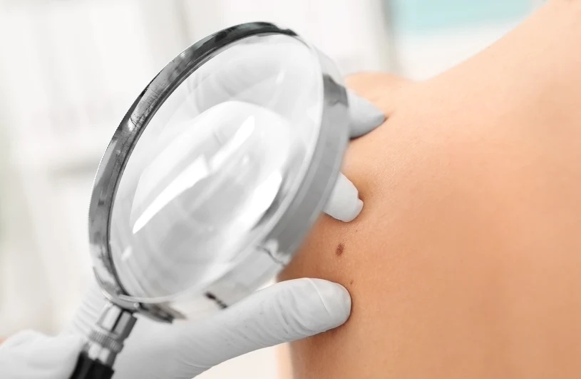 Przełom w badaniach nad rakiem skóry. Odkryto najważniejszy mechanizm ochrony