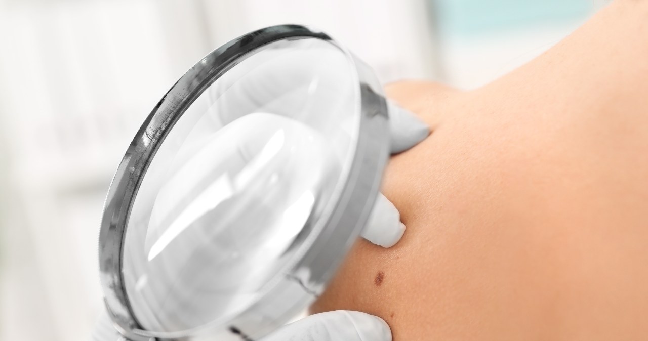 Przełom w badaniach nad rakiem skóry. Odkryto najważniejszy mechanizm ochrony