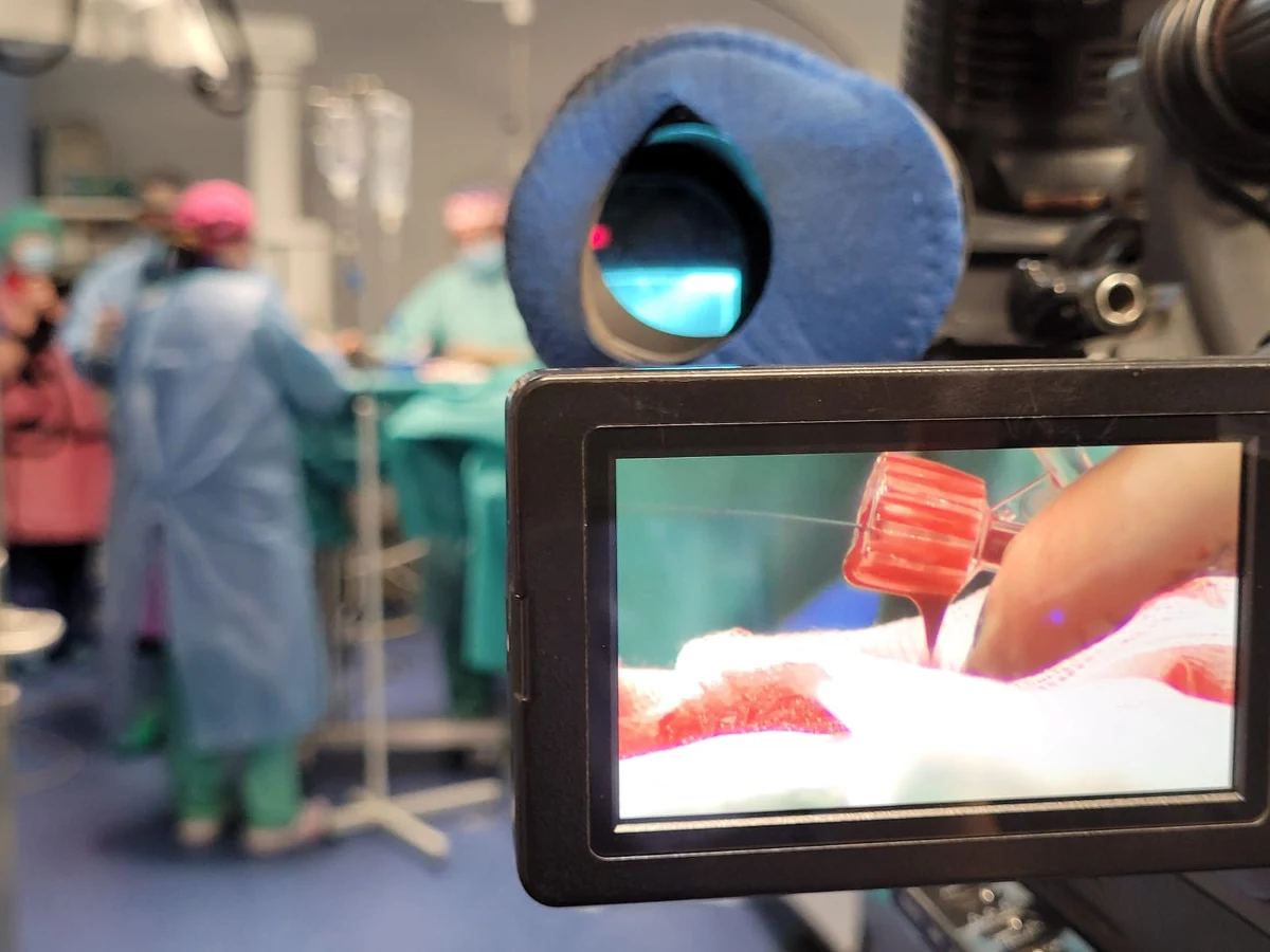 Trzy operacje zaawansowanej zakrzepicy żył głębokich przeprowadzili lekarze z Samodzielnego Publicznego Szpitala Klinicznego nr 1 (SPSK1) w Lublinie. To pierwsze takie operacje w Polsce z zastosowaniem nowej i mniej inwazyjnej metody. To „inteligentny zestaw aspiracyjny Penumbra z cewnikiem ssącym".