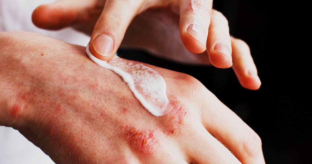 Dla suchej skóry nie ma nic lepszego. Kupisz w każdej aptece i nie pożałujesz