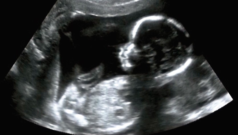 Ogromny sukces lekarzy. Zoperowali mózg dziecka jeszcze w łonie matki