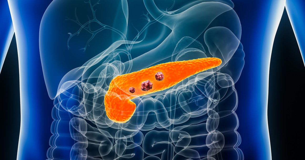 Odkryli, jak zmusić raka trzustki do kapitulacji. Rewolucyjna terapia