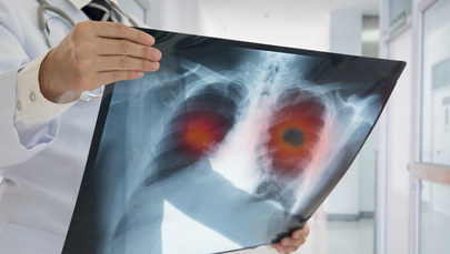 Czy astma może powodować raka? 