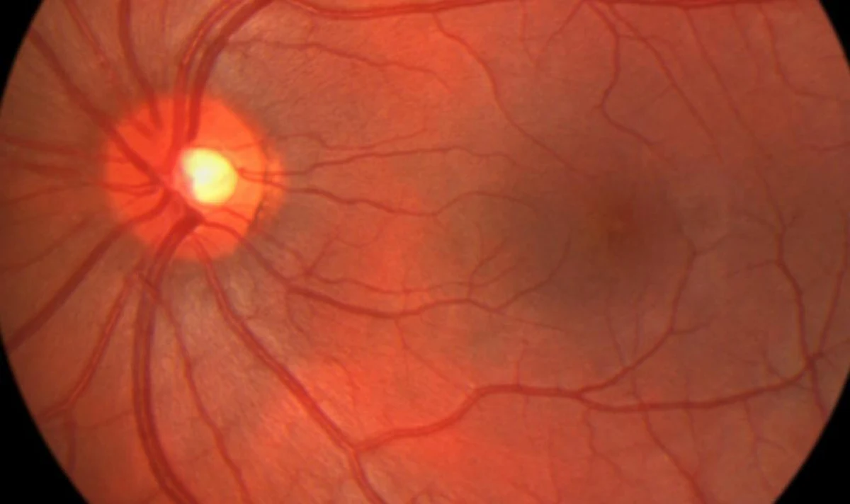 ​Co zrobić, żeby nie zachorować na AMD - starcze zwyrodnienie plamki żółtej oka? Odpowiednio ją odżywić, dostarczając dostępne w warzywach składniki luteinę i zeaksantynę. Im ich więcej, tym zdrowiej dla oczu. Wyniki badań naukowców z Uniwersytetu Marii Curie-Skłodowskiej oraz okulistów z Uniwersytetu Medycznego w Lublinie opublikowano w prestiżowym czasopiśmie naukowym "International Journal of Molecular Sciences".