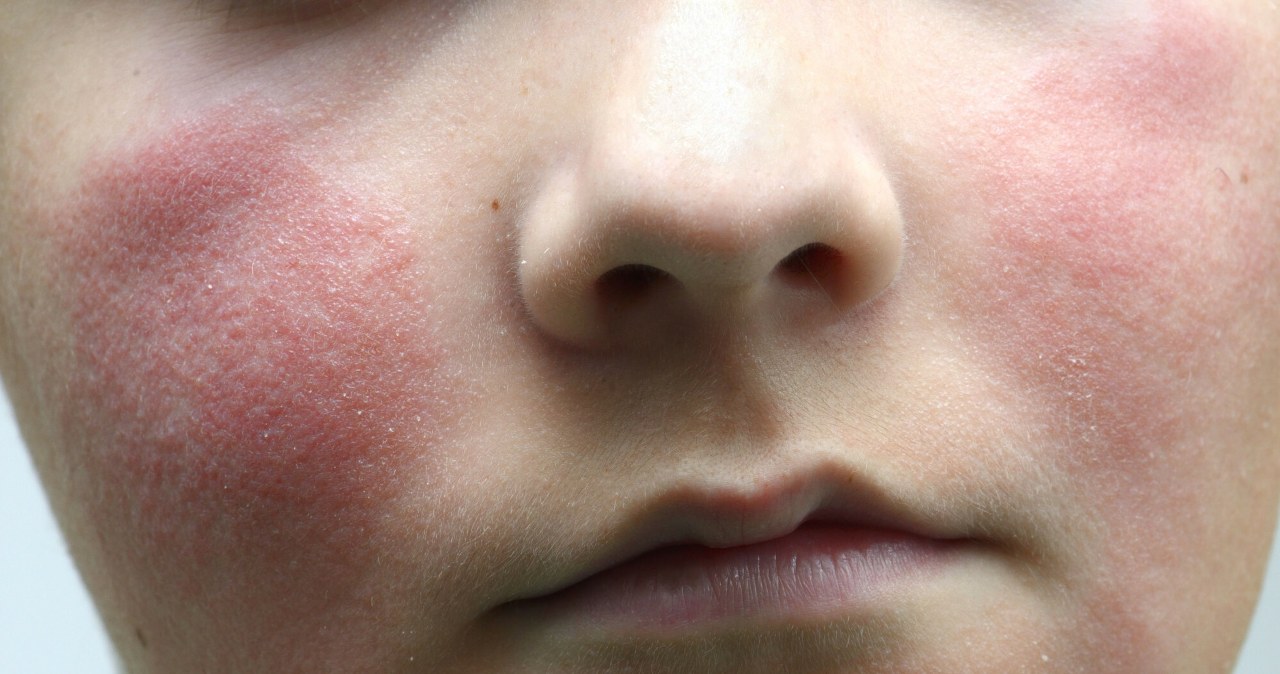 Rumień zakaźny, czyli piąta choroba. Przyczyny, objawy i leczenie