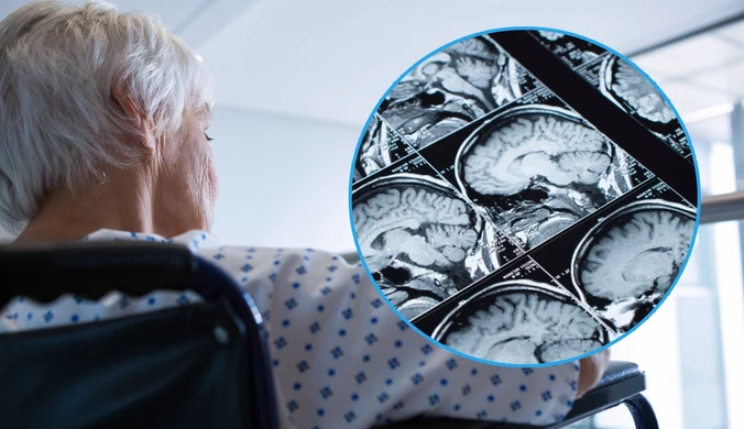 Naukowcy mówią o rozwiązaniu zagadki alzheimera. "Mamy wskazówkę"