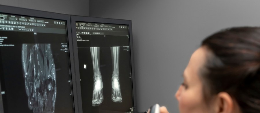 ​W ostrowskim szpitalu powołano ośrodek szkoleniowy leczenia złamań kości piętowej - jedyny taki w Polsce.  To zasługa ostrowskich ortopedów, którzy od lat stosują w leczeniu skomplikowanych złamań tzw. metodę gwoździa - poinformowało Starostwo Powiatowe w Ostrowie Wlkp.