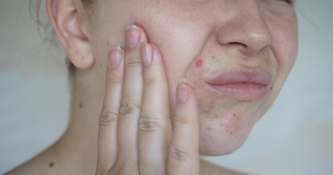 Wiele kobiet popełnia ten błąd. Przez niego mają kłopoty z cerą