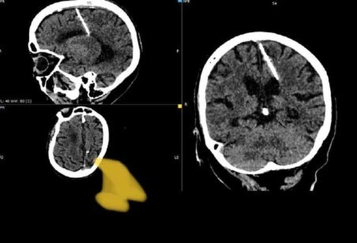 Starsza kobieta z dalekiego wschodu Rosji przeżyła 80 lat z 3-centymetrową igłą w mózgu. Odkryli to przypadkiem lekarze, którzy badali ją za pomocą tomografii komputerowej - poinformował „The Guardian”, powołujący się na lokalne władze medyczne.