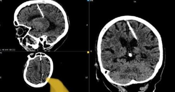 Starsza kobieta z dalekiego wschodu Rosji przeżyła 80 lat z 3-centymetrową igłą w mózgu. Odkryli to przypadkiem lekarze, którzy badali ją za pomocą tomografii komputerowej - poinformował „The Guardian”, powołujący się na lokalne władze medyczne.