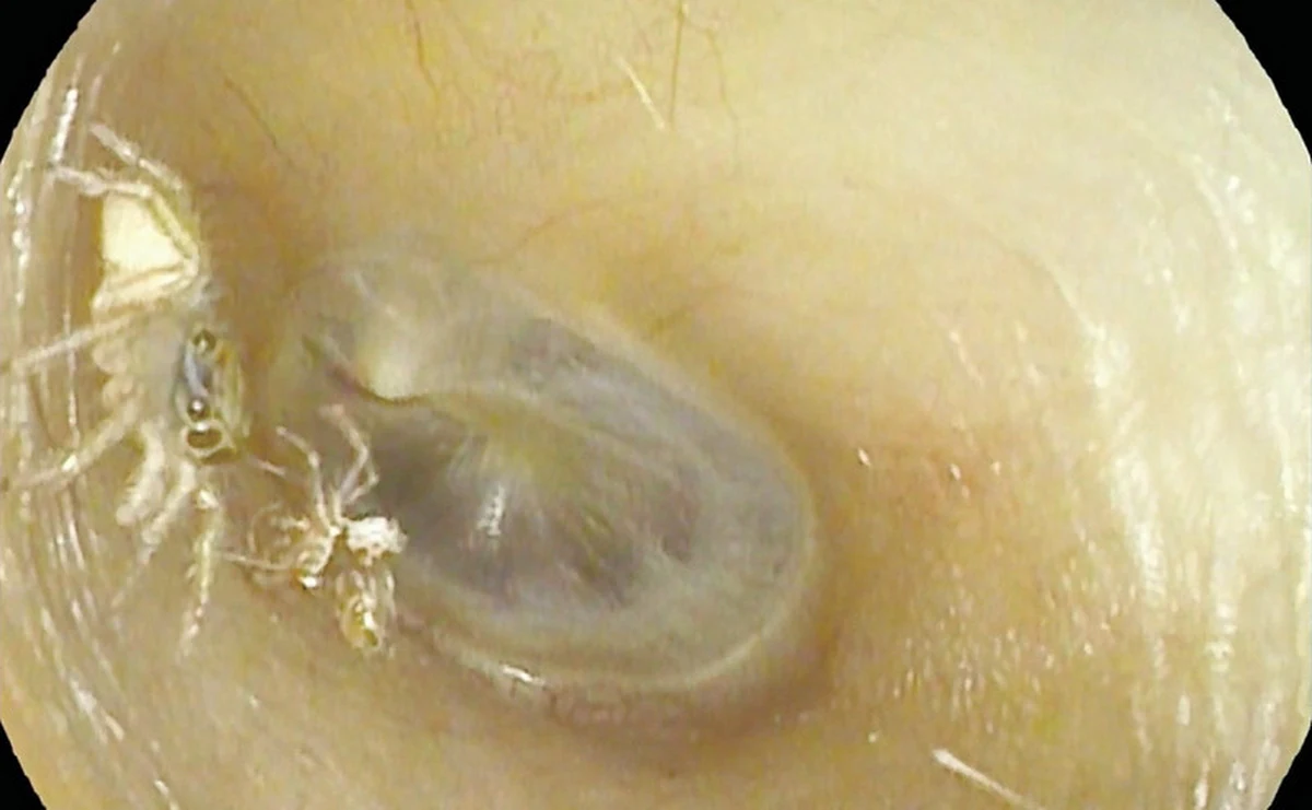 To historia, która przyprawia o gęsią skórkę. 64-letnia Tajwanka przez kilka dni i nocy słyszała w lewym uchu nieustanny "szelest i klikanie". Chcąc sprawdzić, co jest powodem dolegliwości, poszła do poradni laryngologicznej. Badanie wykazało coś przerażającego - w jej uchu znajdował się mały pająk i egzoszkielet, który po sobie pozostawił.