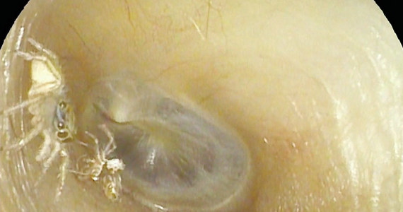To historia, która przyprawia o gęsią skórkę. 64-letnia Tajwanka przez kilka dni i nocy słyszała w lewym uchu nieustanny "szelest i klikanie". Chcąc sprawdzić, co jest powodem dolegliwości, poszła do poradni laryngologicznej. Badanie wykazało coś przerażającego - w jej uchu znajdował się mały pająk i egzoszkielet, który po sobie pozostawił.
