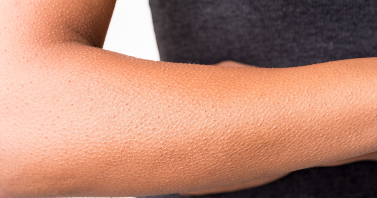Sekrety gęsiej skórki. Dlaczego ciało dostaje ciarek?