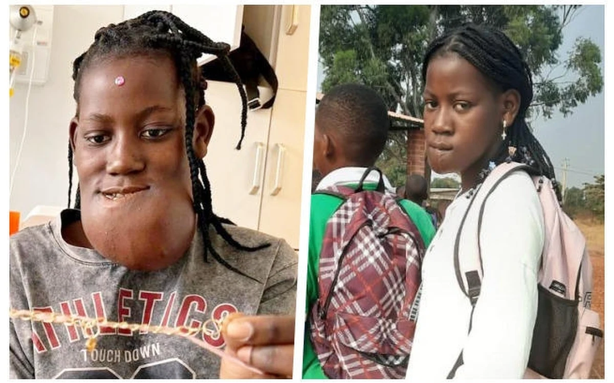 Lekarze z Wojewódzkiego Specjalistycznego Szpitala Dziecięcego w Olsztynie ponownie chcą pomóc 15-letniej Cristinie. Nastolatka w czerwcu przyleciała do Olsztyna z Afryki na operację olbrzymiego guza żuchwy. Teraz potrzebuje odbudowania uzębienia. 