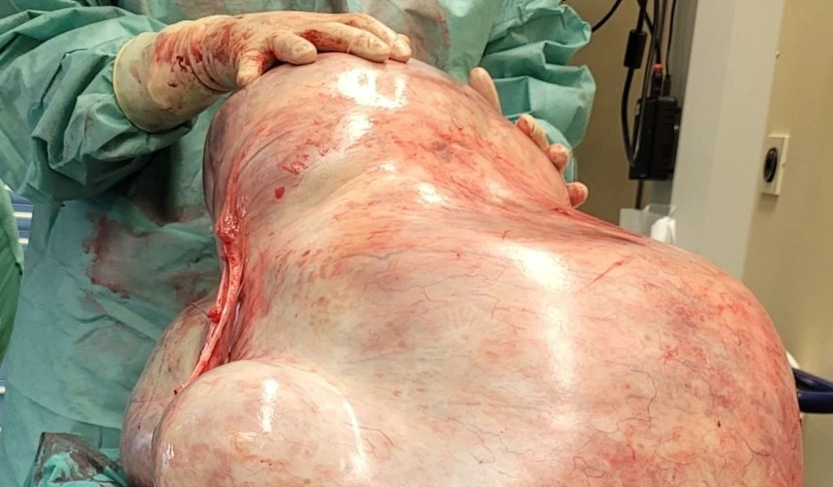 Lekarze z Magdeburga w Niemczech usunęli z brzucha 24-letniej pacjentki olbrzymiego guza. Ważył 32 kilogramy. 