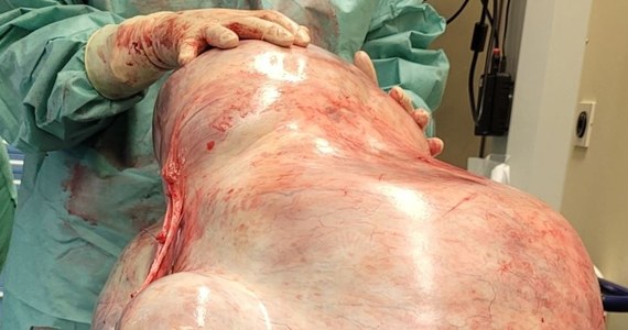 Lekarze z Magdeburga w Niemczech usunęli z brzucha 24-letniej pacjentki olbrzymiego guza. Ważył 32 kilogramy. 