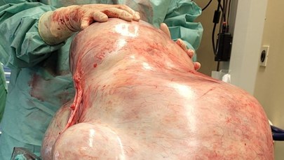 32-kilogramowy guz w brzuchu młodej kobiety