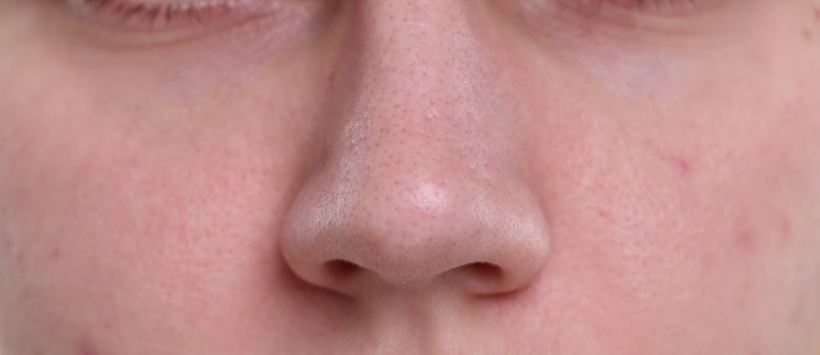 Drobna wysypka na twarzy, potocznie określana jako „kaszka” to niewielkich rozmiarów, podskórne grudki, które zazwyczaj występują w większych skupiskach. Pojawiają się przede wszystkim w obrębie skóry czoła oraz policzków. Zmiany mogą dotyczyć dorosłych jak i dzieci. 