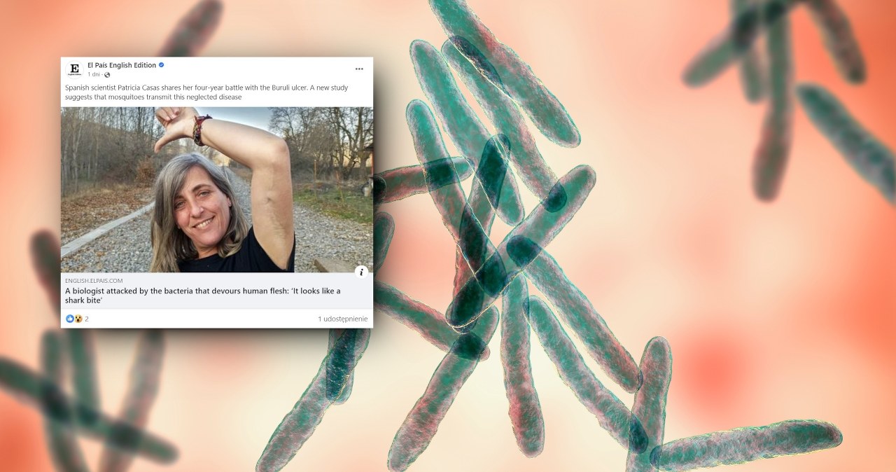 Biolożka zaraziła się dziwną bakterią. Blizna wygląda jak po ataku rekina Biolożka zaraziła się dziwną bakterią. Blizna wygląda jak po ataku rekina