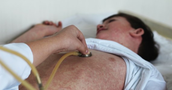 W minionym tygodniu w Rumunii zarejestrowano 559 przypadków zarażenia odrą, a od stycznia 2023 r. do 13 lutego potwierdzono 5238 zachorowań. W grudniu zeszłego kraju ogłoszono w tym kraju epidemię odry.