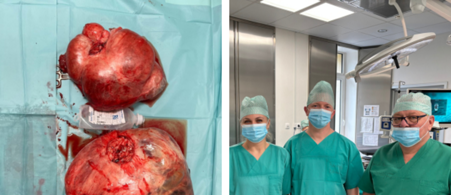 To jeden z największych tego typu guzów wyciętych w Polsce. W Szpitalu im. Rudolfa Weigla w Blachowni przeprowadzono operację u pacjentki z dużym guzem macicy, ważącym aż 26 kilogramów. 