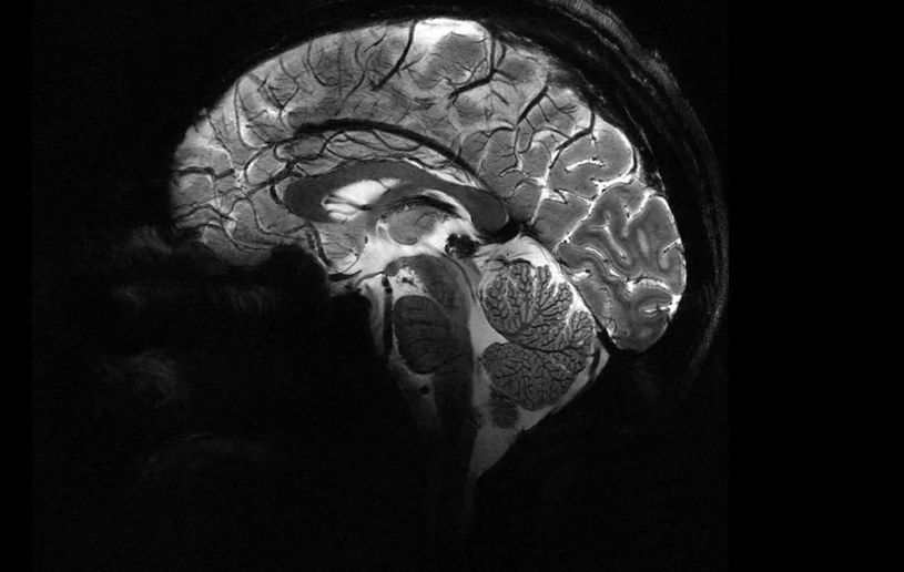 Najpotężniejsze urządzenie do rezonansu magnetycznego na świecie pokazuje swoją wartość. Dostarcza pierwsze skany mózgu w ultrawysokiej rozdzielczości, co pomoże lepiej zrozumieć naturę świadomości i leczyć choroby neurodegeneracyjne.