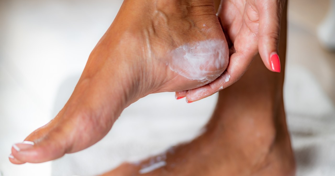 Smaruj nią pięty, zanim założysz klapki. Maść z apteki wygładzi skórę