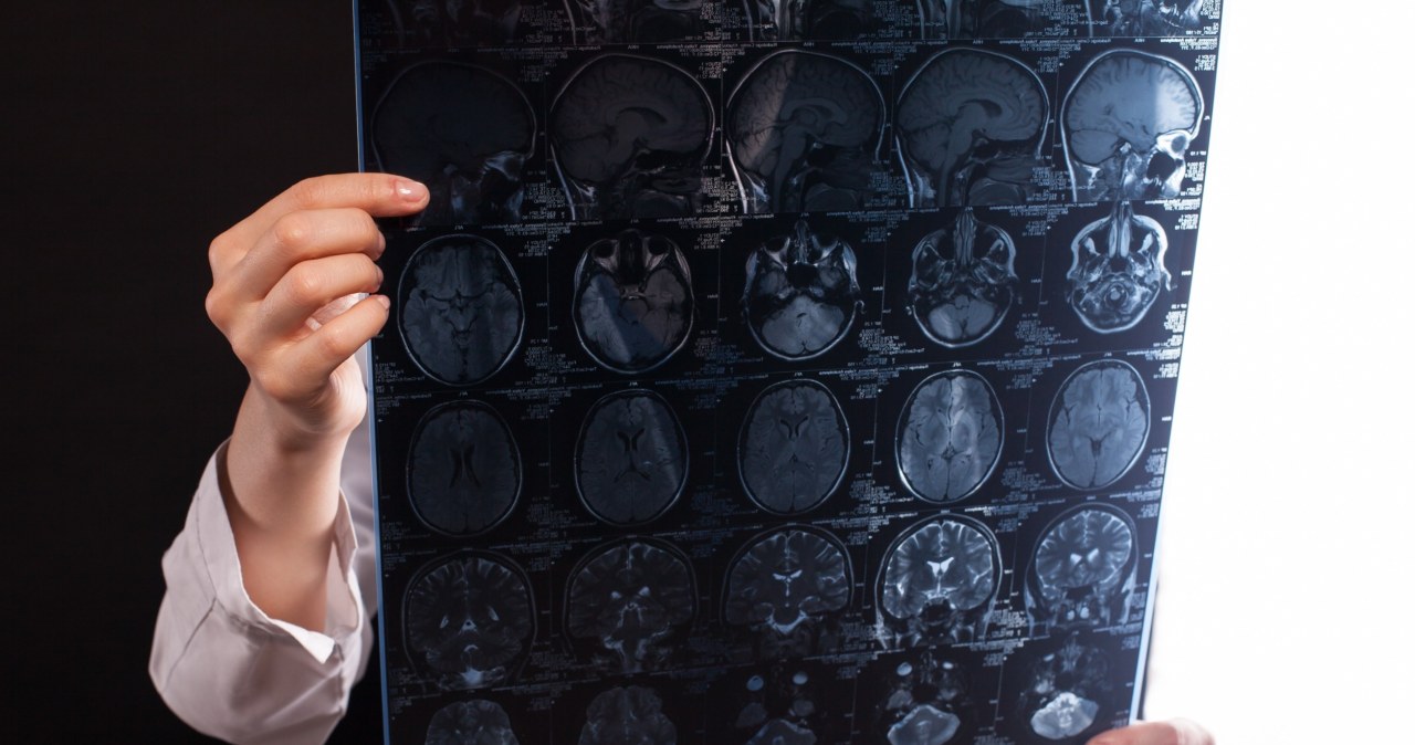 Lekarze już wiedzą. To dlatego kobiety są bardziej narażone na Alzheimera i stwardnienie rozsiane