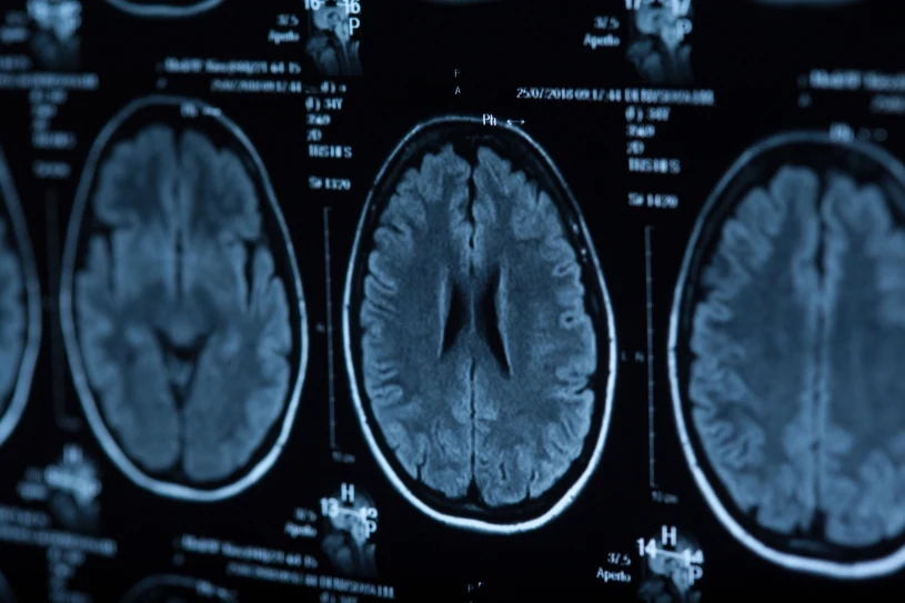 Nowe fakty o mózgu psychopatów. Odkryto wyraźne różnice biologiczne