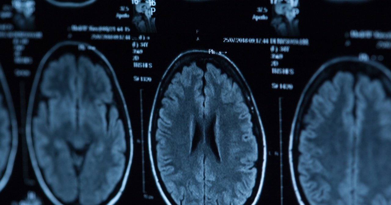 Nowe fakty o mózgu psychopatów. Odkryto wyraźne różnice biologiczne