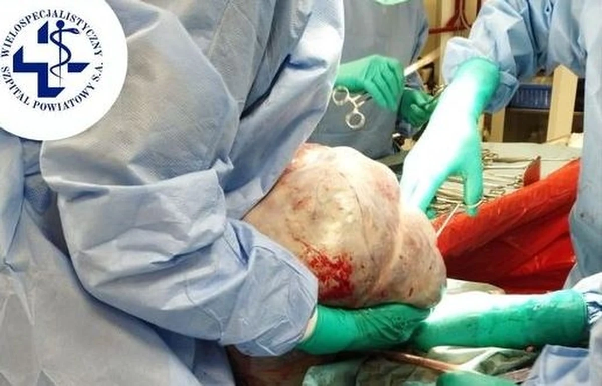 19-kilogramowego guza jajnika usunęli 60-letniej pacjentce lekarze z oddziału ginekologiczno-położniczego Wielospecjalistycznego Szpitala Powiatowego w Tarnowskich Górach.