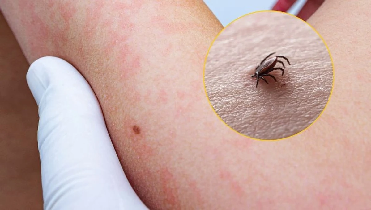 9134 przypadki boreliozy i 159 kleszczowego zapalenia mózgu potwierdzono w Polsce tylko od początku tego roku - wynika z danych Narodowego Instytutu Zdrowia Publicznego - Państwowego Zakładu Higieny o zachorowaniach na choroby zakaźne. To więcej niż w tym samym okresie 2023 roku.