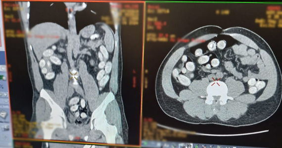 Ponad 1 kg kokainy przemycał w żołądku 35-letni Nigeryjczyk zatrzymany na Lotnisku Chopina - poinformowała Krajowa Administracja Skarbowa. Grozi mu do 20 lat więzienia. 