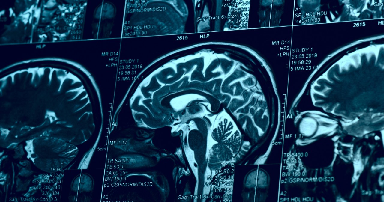 Leczenie "made ich China". Wiedzą, jak cofnąć Parkinsona