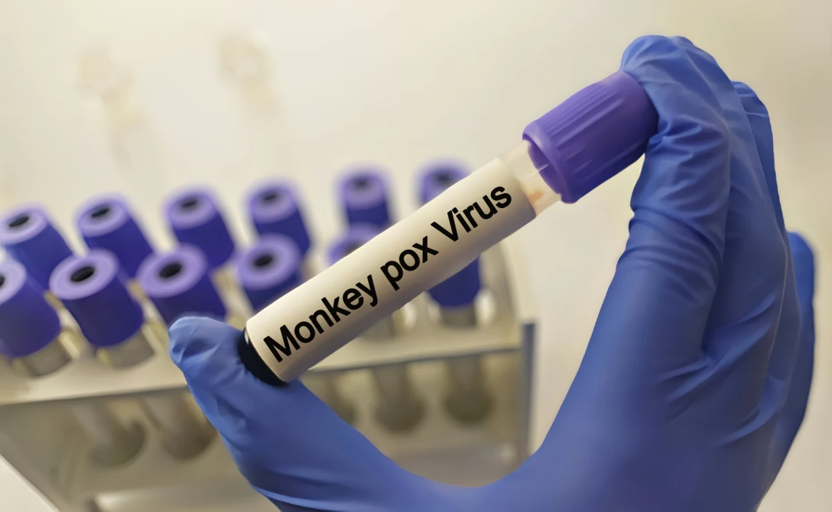 W regionie obejmującym Sztokholm potwierdzono w czwartek pierwszy poza kontynentem afrykańskim przypadek nowej, bardziej zaraźliwej odmiany małpiej ospy (mpox). Według szwedzkich władz pacjentem jest osoba przebywająca wcześniej w miejscu, gdzie występuje ognisko choroby.