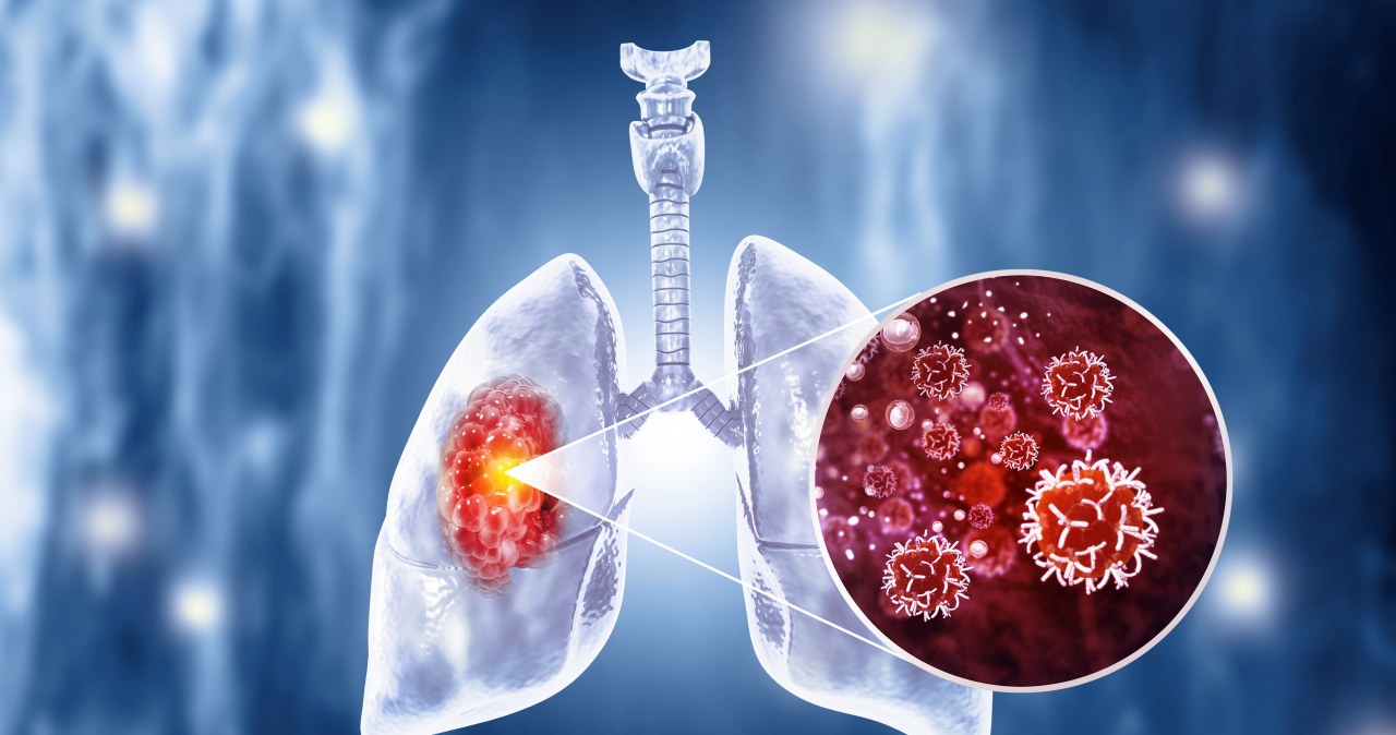 Leczenie raka płuc może być skuteczniejsze dzięki prostemu rozwiązaniu