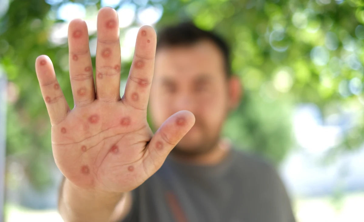 W Niemczech zanotowano pierwszy przypadek nowego wariantu małpiej ospy. Chory pacjent przebywa w szpitalu. Nowy przypadek zarejestrowano także w Norwegii. Wirus atakuje jednak przede wszystkim w Afryce.