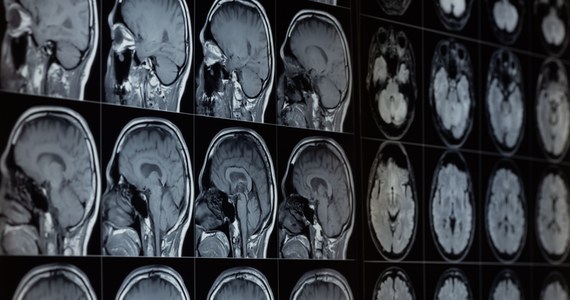 Sztuczna inteligencja nie zawsze pomaga. Jak wynika z badania opublikowanego w czasopiśmie "Radiology", AI może wprowadzać w błąd radiologów, którzy zbytnio polegają na jej podpowiedziach. Naukowcy przekonują, że między nowymi technologiami sztucznej inteligenci a możliwością ich praktycznego zastosowania w medycynie jest jeszcze spory rozdźwięk.