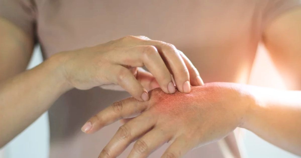 Łuszczyca to choroba autoimmunologiczna. Choć nieuleczalna, można mieć ją pod kontrolą