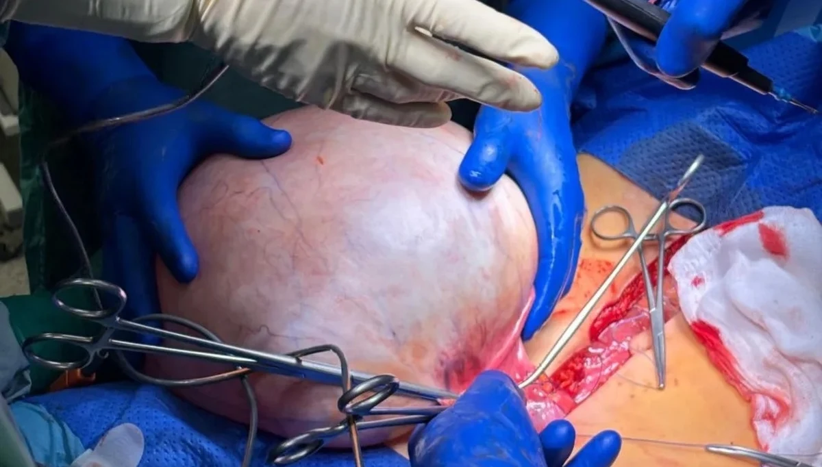 Mierzył 30 cm i ważył 8 kg. Lekarze ze Szpitala Miejskiego w Zabrzu usunęli pacjentce gigantyczny guz jajnika. To okazja, by przypomnieć, że regularne badania ginekologiczne są kluczowe przy wczesnym wykrywaniu tego typu zmian.