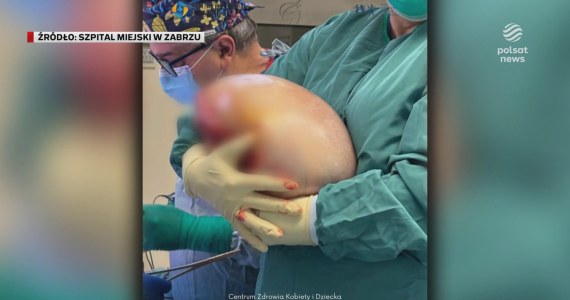 "Wydarzenia": Ogromny guz w ciele pacjentki. Ważył prawie 8 kilogramów