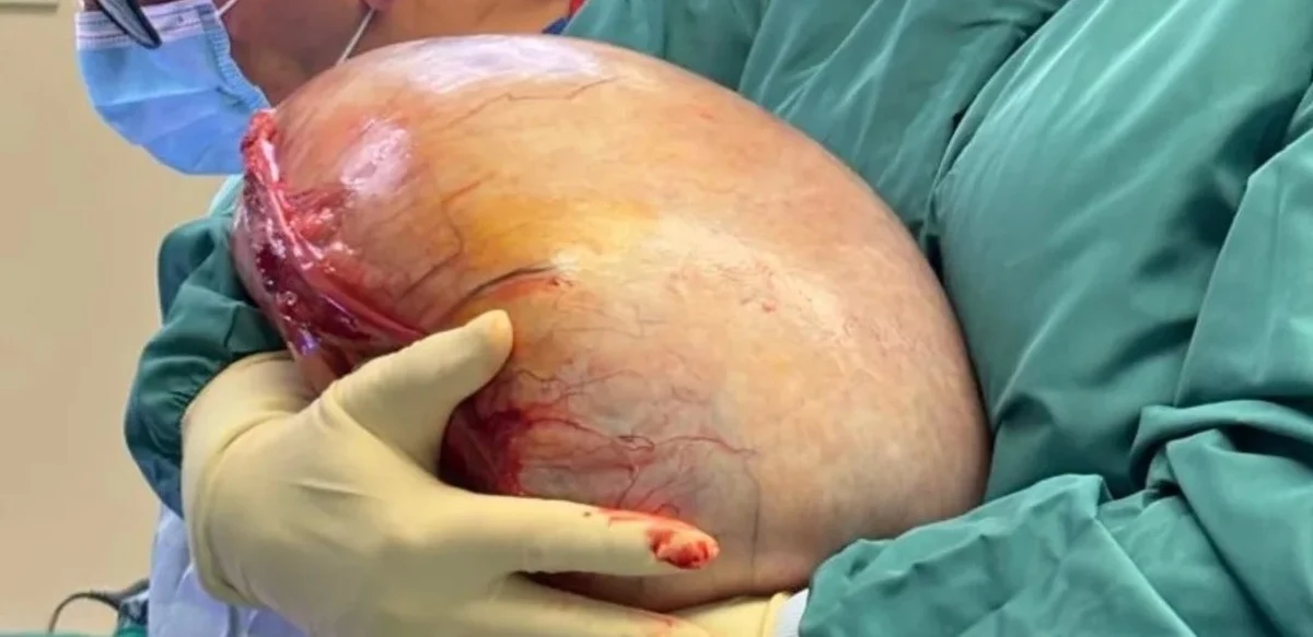 Najprawdopodobniej ponad rok rósł gigantyczny guz jajnika, którego niedawno usunęli 23-letniej pacjentce lekarze ze Szpitala Miejskiego w Zabrzu. Mierzył 30 cm i ważył 8 kg. Jak tłumaczy w rozmowie z RMF FM kierujący zabrzańskim oddziałem ginekologiczno-położniczym dr Mariusz Wójtowicz, guz naciskał na naczynia żylne, co było bezpośrednim zagrożeniem życia pacjentki.