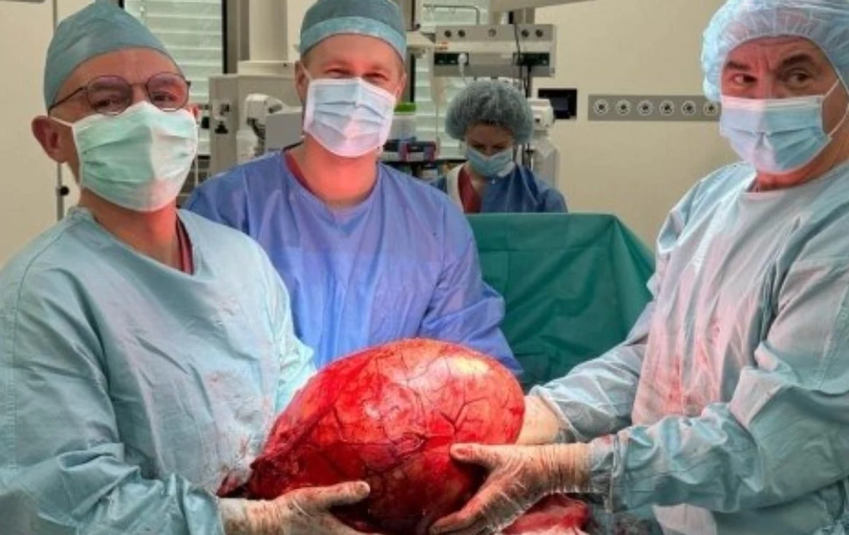 14 kilogramów ważył guz nerki, który usunęli 66-letniemu pacjentowi lekarze z Zespołu Oddziału Urologii i Urologii Onkologicznej Szpitala św. Wojciecha w Gdańsku. 