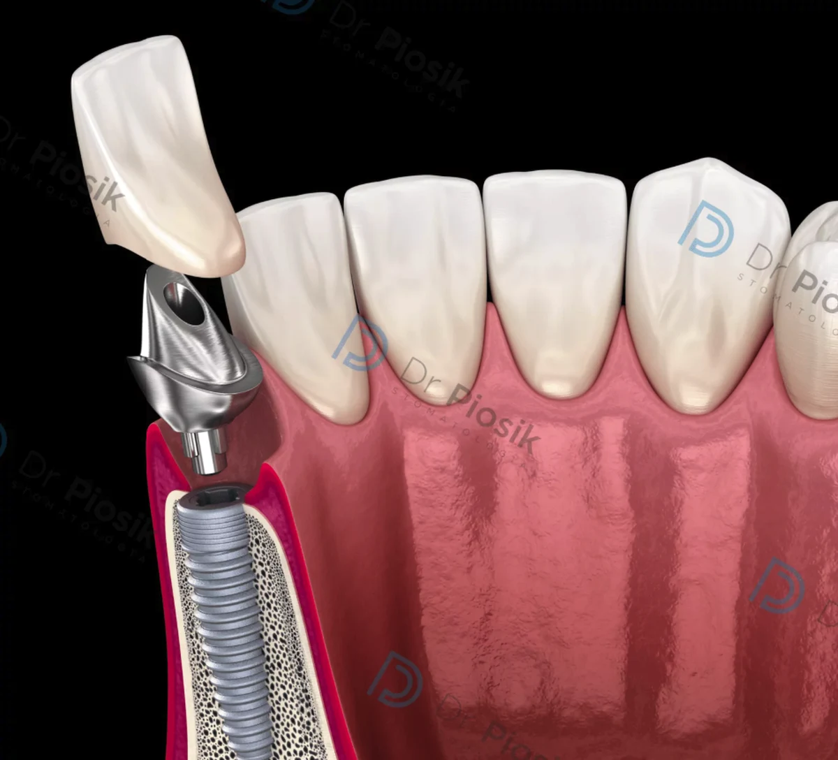 Historia implantologii to fascynująca opowieść o ludzkiej pomysłowości i dążeniu do przywrócenia funkcji i estetyki uzębienia. Od prymitywnych prób w starożytnych cywilizacjach po zaawansowane technologie robotyczne – rozwój tej dziedziny jest imponujący. Przyjrzyjmy się, jak technologia odmieniła oblicze stomatologii.