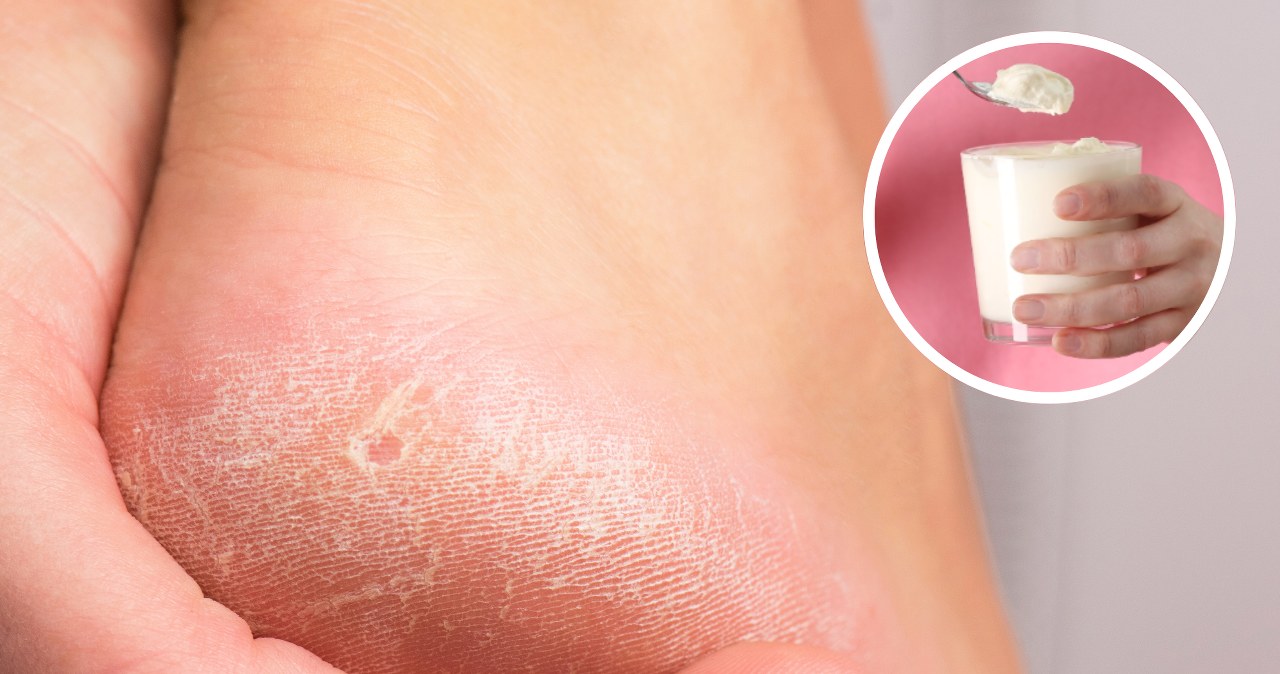 Wyjmij z lodówki wetrzyj w stopy. Będą miękkie i gładkie jak po wizycie u kosmetyczki