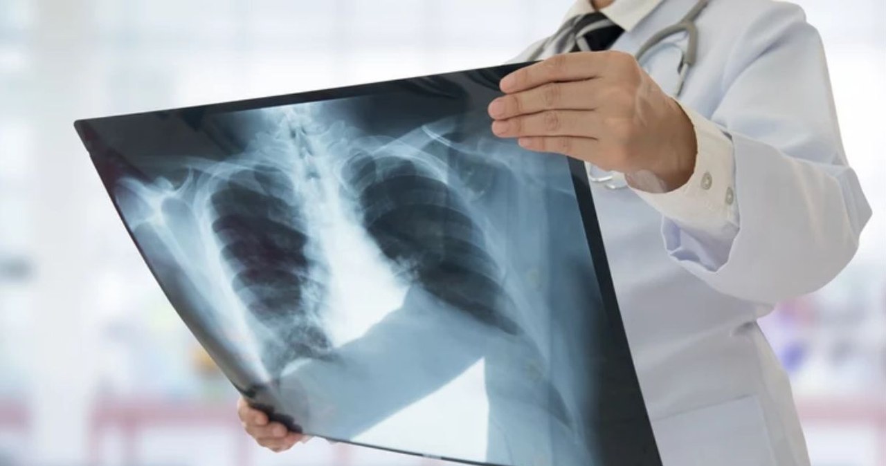 To największy na świecie zakaźny zabójca. 1,23 mln zgonów w 2024 r.