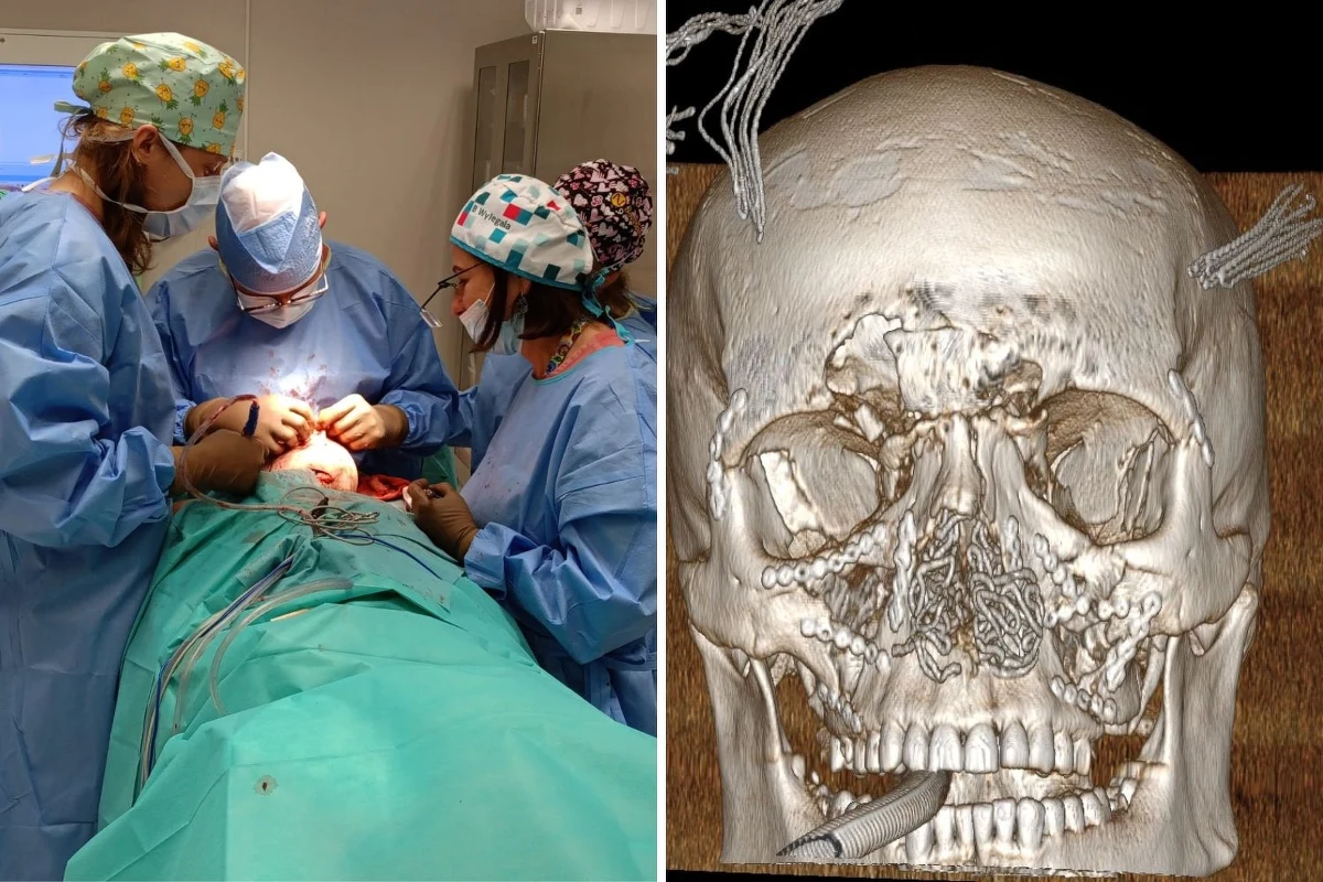 Bardzo skomplikowany zabieg przeprowadzili lekarze z Górnośląskiego Centrum Zdrowia Dziecka w Katowicach. Jak poinformowano, chirurdzy szczękowo-twarzowi zrekonstruowali niemal całą twarz nastolatka, który uległ ciężkiemu wypadkowi.