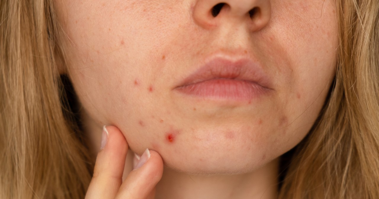 Pryszcze przed ważnym wydarzeniem? Ta maść za grosze usunie je w 1 noc