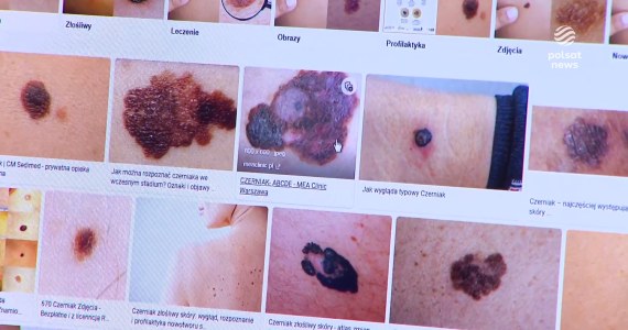 ''Wydarzenia'': Przed nami lato i dużo słońca. Lekarze apelują o badanie profilaktyczne skóry