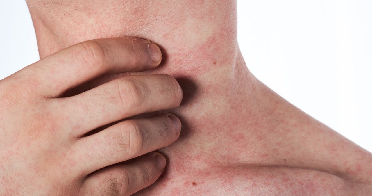 Swędzi, piecze, pęka? Sprawdź, czy to nie stres odbija się na twojej skórze